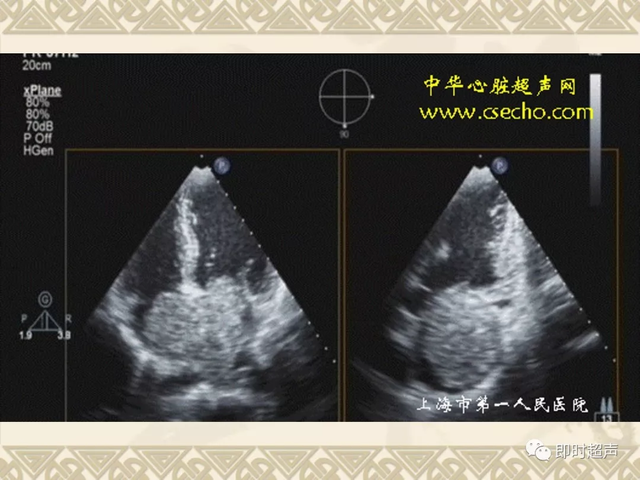 25种常见心脏疾病超声诊断1126 作者:笔墨苍炎 帖子ID:20241 常见心脏疾病