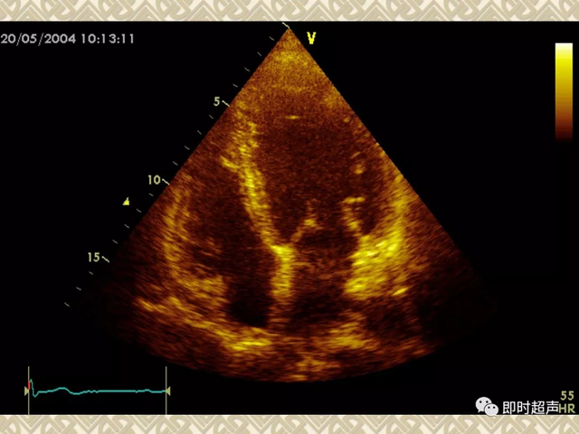 25种常见心脏疾病超声诊断3468 作者:笔墨苍炎 帖子ID:20241 常见心脏疾病