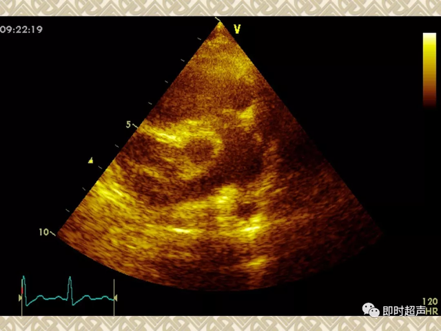 25种常见心脏疾病超声诊断3715 作者:笔墨苍炎 帖子ID:20241 常见心脏疾病