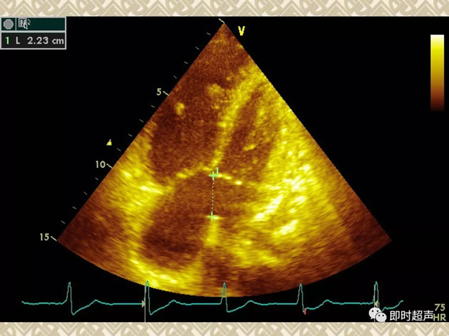 25种常见心脏疾病超声诊断6086 作者:笔墨苍炎 帖子ID:20241 常见心脏疾病