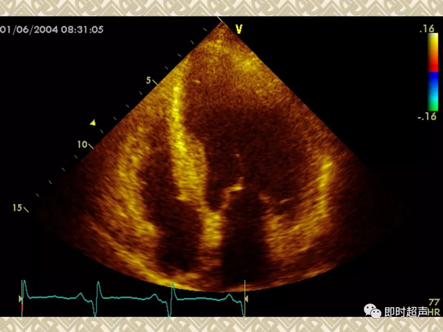 25种常见心脏疾病超声诊断5312 作者:笔墨苍炎 帖子ID:20241 常见心脏疾病