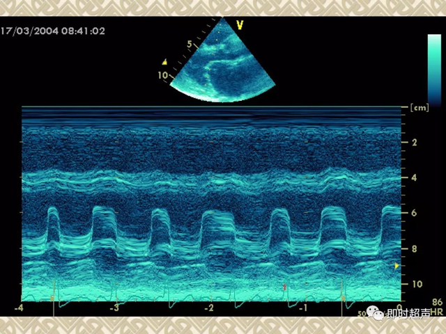 25种常见心脏疾病超声诊断6678 作者:笔墨苍炎 帖子ID:20241 常见心脏疾病