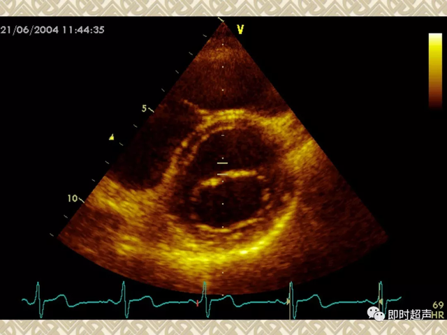 25种常见心脏疾病超声诊断8096 作者:笔墨苍炎 帖子ID:20241 常见心脏疾病