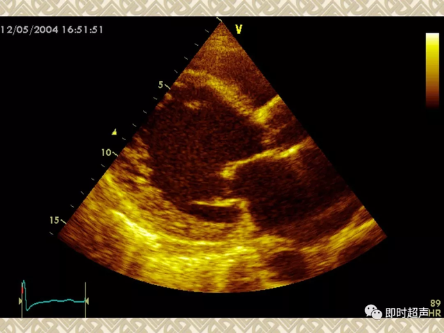25种常见心脏疾病超声诊断9108 作者:笔墨苍炎 帖子ID:20241 常见心脏疾病