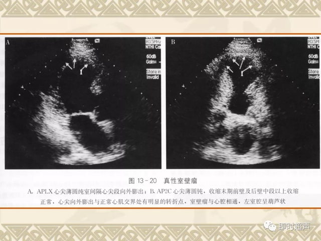 25种常见心脏疾病超声诊断5440 作者:笔墨苍炎 帖子ID:20241 常见心脏疾病