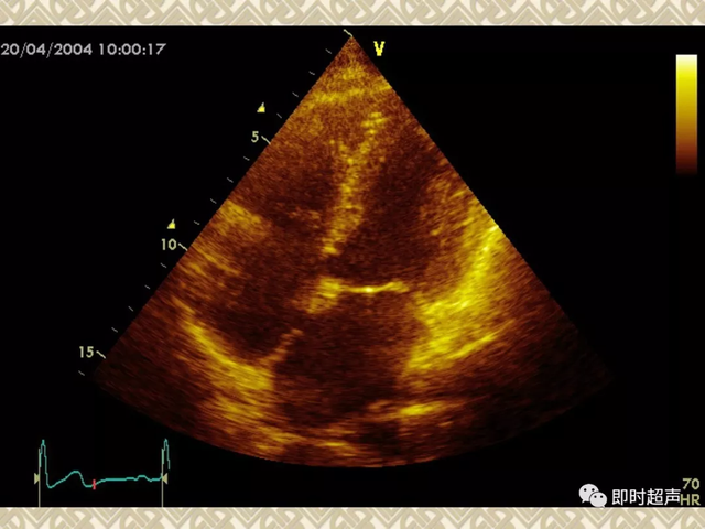 25种常见心脏疾病超声诊断7130 作者:笔墨苍炎 帖子ID:20241 常见心脏疾病